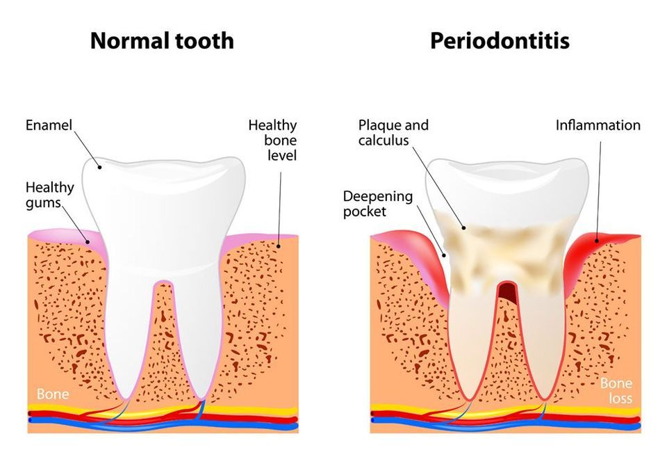 illustration of periodontal disease