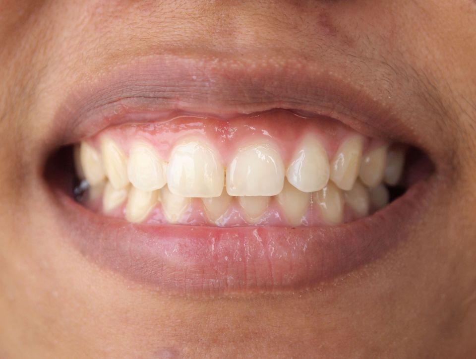 Crown lengthening can create a more attractive tooth-to-gum ratio or prepare teeth for restorations.