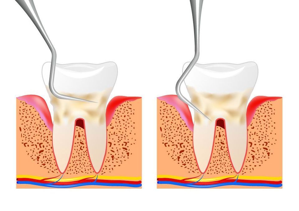 Unlike a regular dental cleaning, scaling and root planing can eradicate bacteria from beneath the gum line.