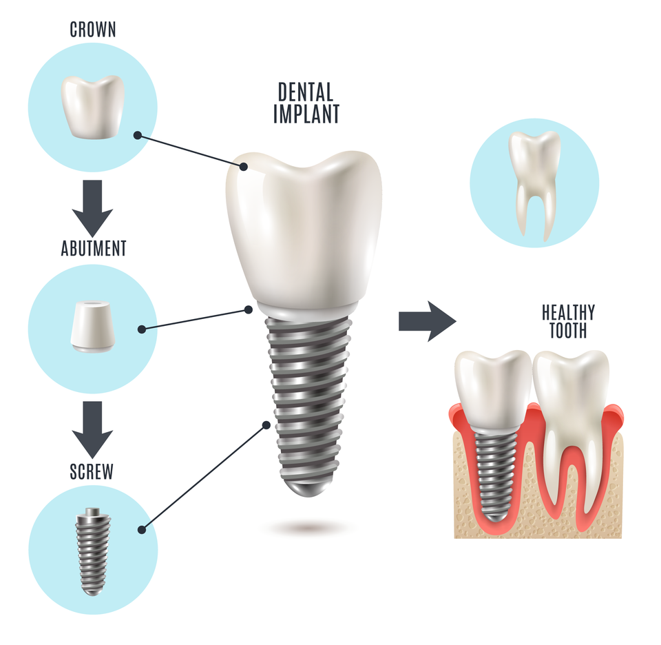 A dental implant, when paired with a restoration, replaces the entire tooth structure.