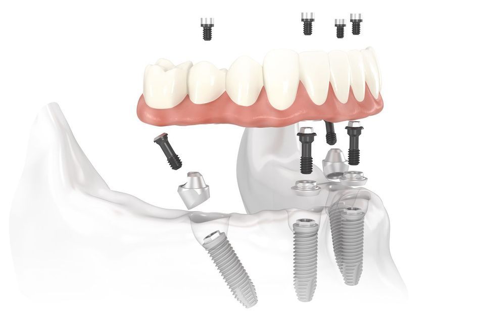 Unlike traditional implants, posts placed using the All-on-4 method are inserted at an angle. This helps maximize the available tissue in the jaw.