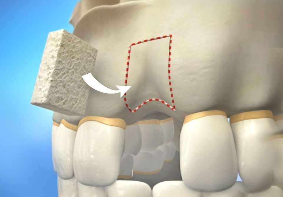 A dental bone graft replaces lost tissue so you can safely receive a dental implant.