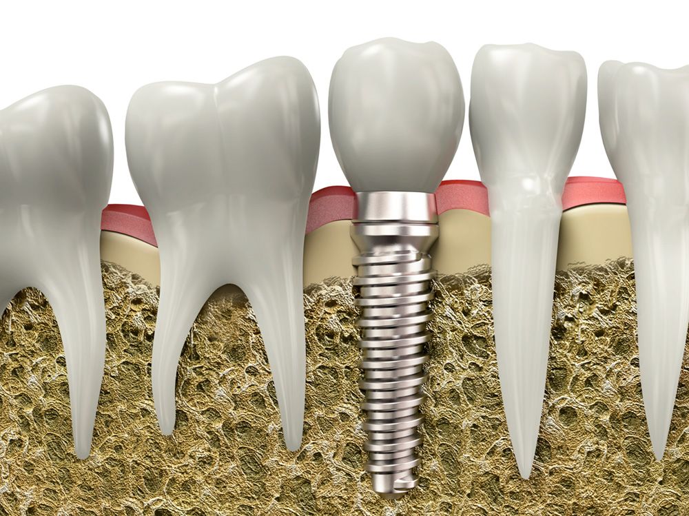 You will need a certain amount of jawbone tissue to support dental implants