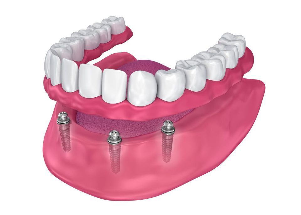 Implant-supported dentures are connected to the jaw, keeping them firmly in place as you speak and chew.