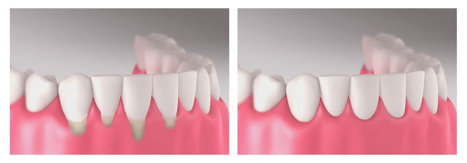 During treatment, we can transplant soft tissue to restore your gums and preserve your oral health.